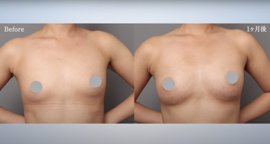 脂肪豊胸の症例（正面）