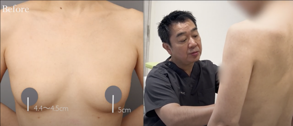 バストトップと乳房下縁の距離