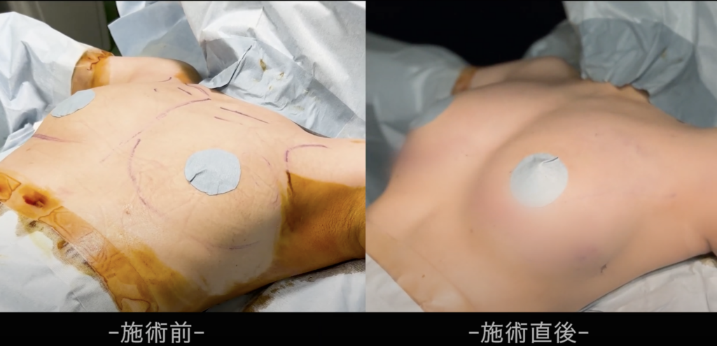 脂肪豊胸のビフォーアフター
