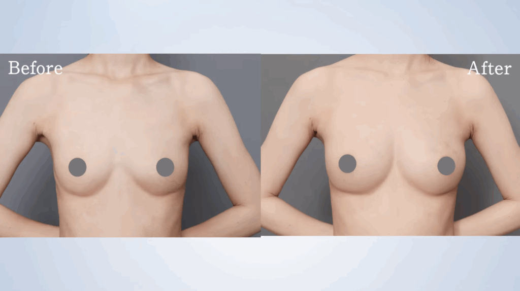 痩せ型の脂肪注入豊胸の症例