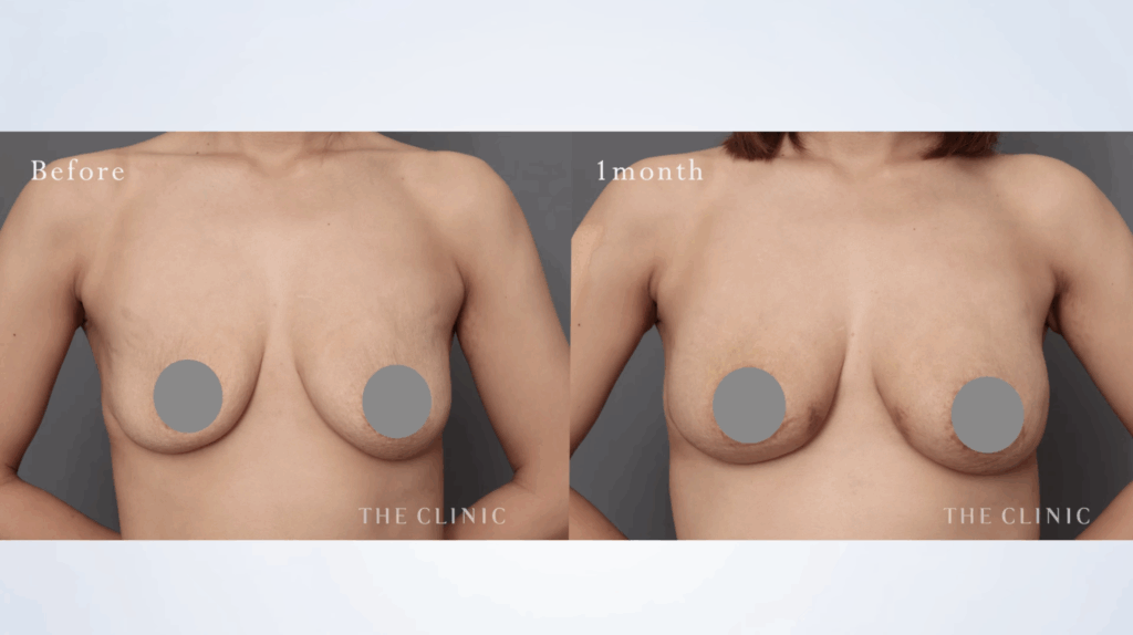 産後・授乳後の脂肪注入豊胸の症例