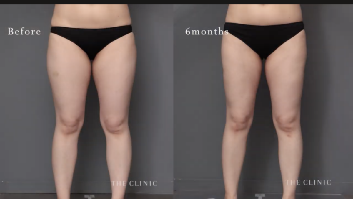 脂肪吸引で太もも痩せ！30代女性、6ヶ月間の激変ストーリー｜THE