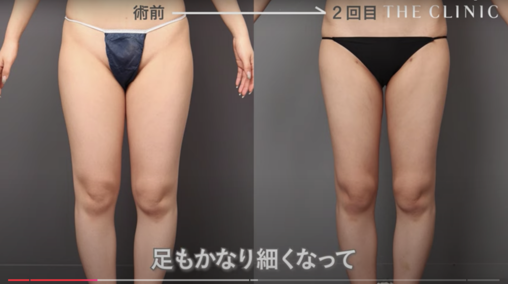 脂肪採取部位（脂肪豊胸の症例）