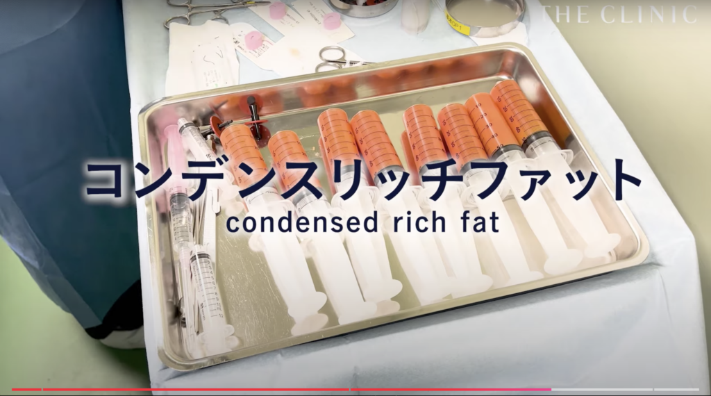 注入脂肪（コンデンスリッチファット）