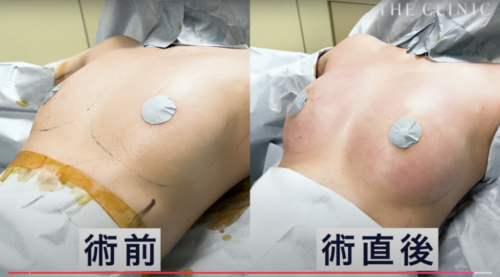 痩せ型の脂肪注入豊胸