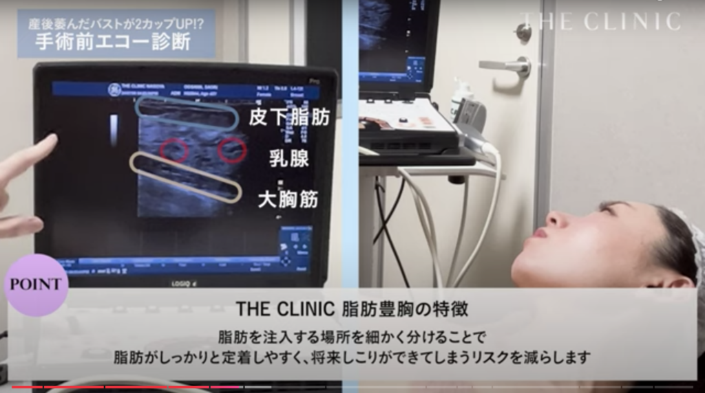 豊胸手術前のエコー検査