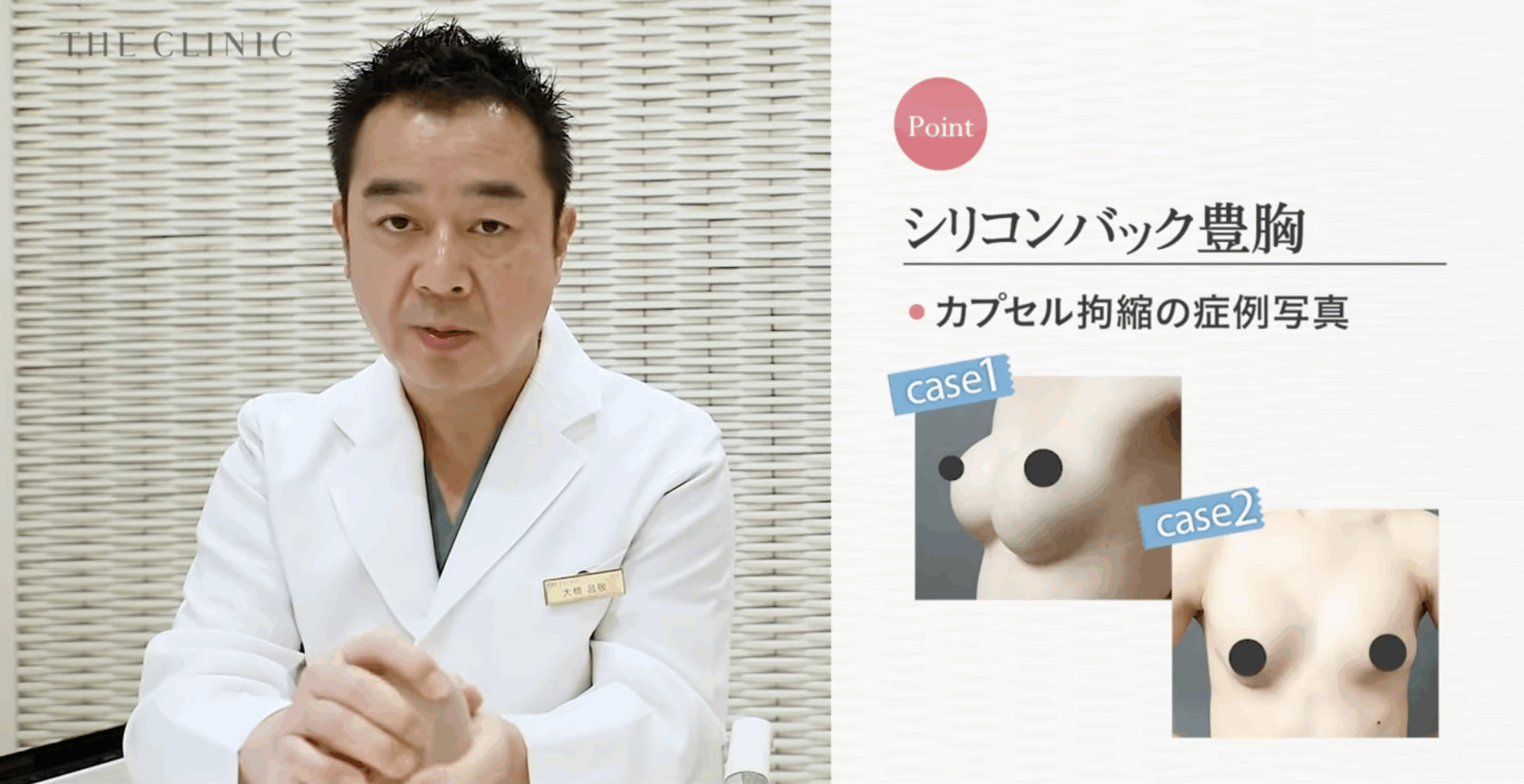 シリコンバッグ豊胸のカプセル拘縮の症例写真
