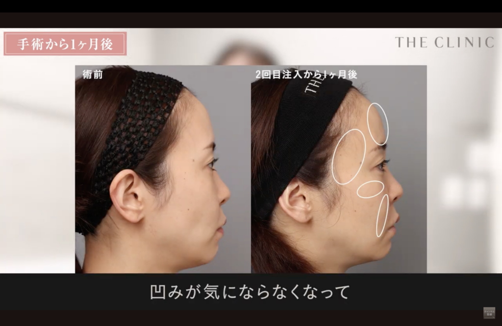 顔の脂肪注入の症例写真