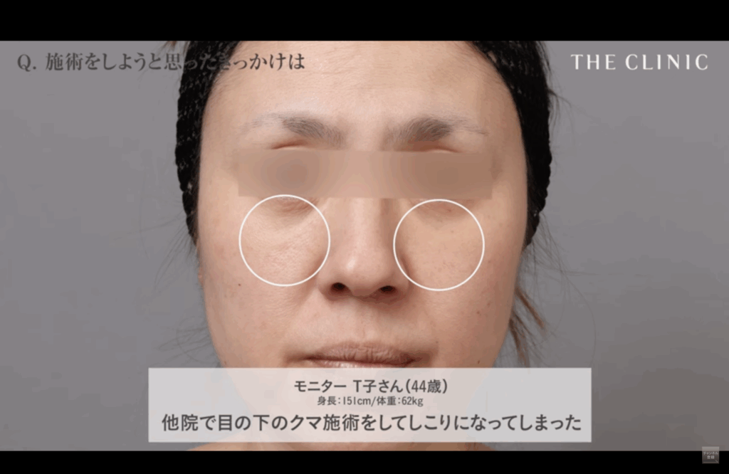 他院で目の下のクマ施術をして凝りになってしまったゲスト