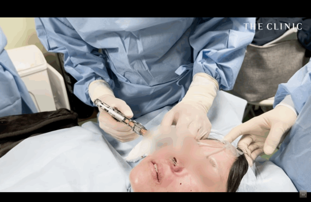 目の下の脂肪注入の様子