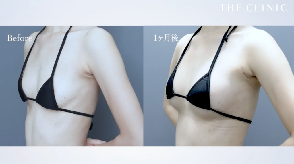 脂肪注入豊胸の症例写真