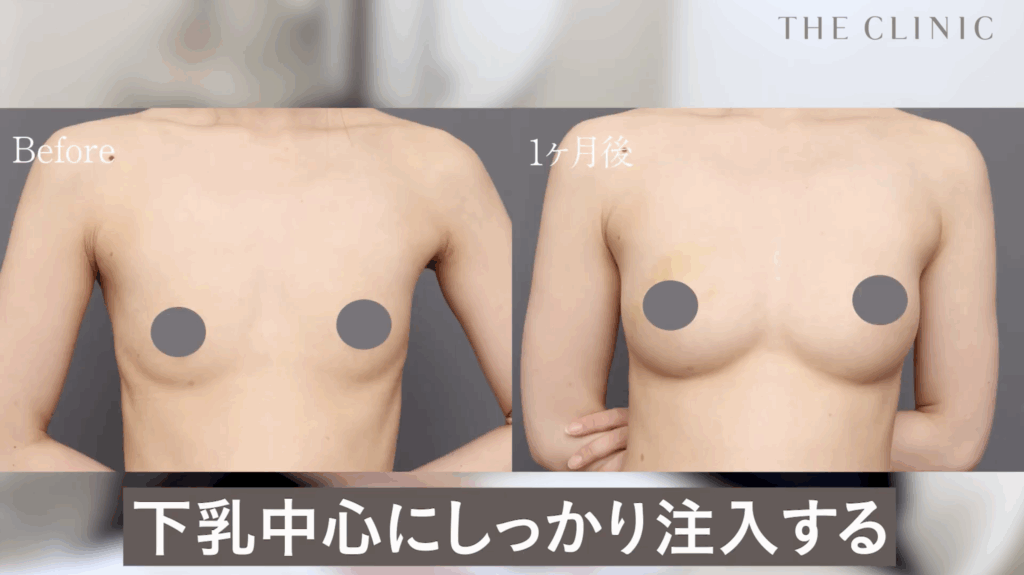 痩せ型の脂肪注入豊胸の症例