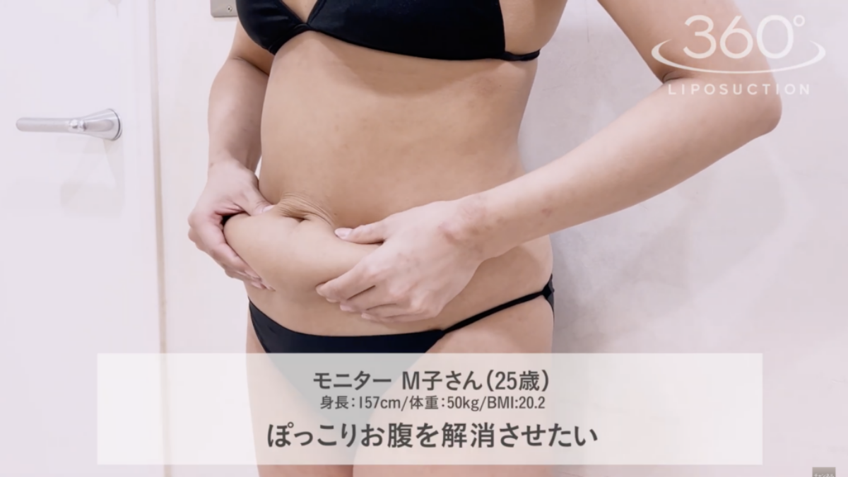 360°脂肪吸引でぽっこりお腹を改善！｜THE CLINIC（ザクリニック）【公式】