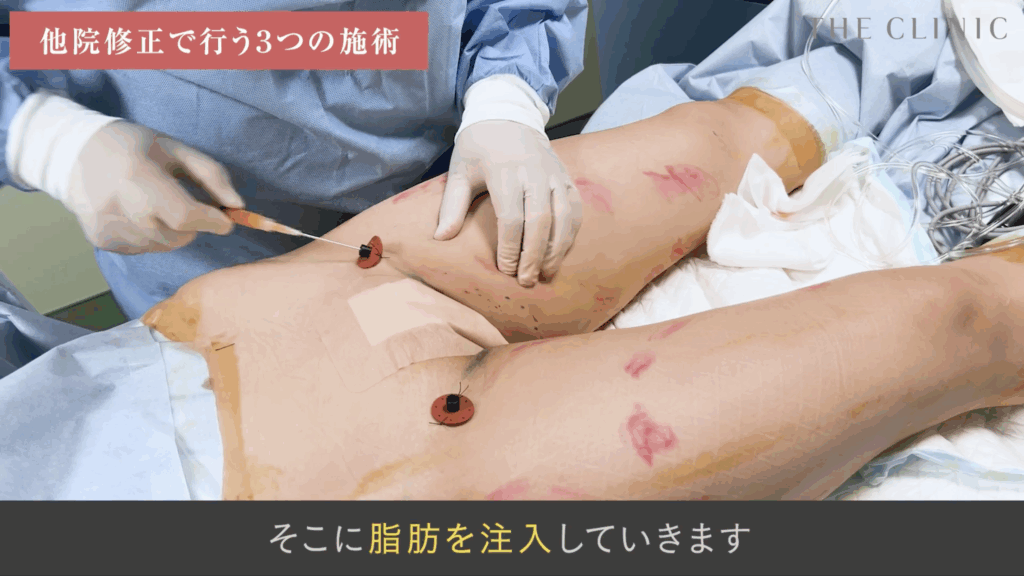 太ももに脂肪注入している様子