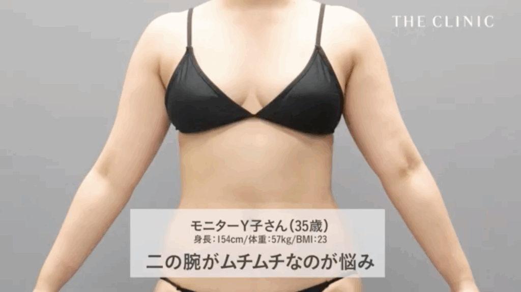 二の腕脂肪吸引を決意したゲストのお悩み