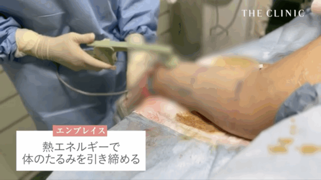 エンブレイスRFを行っている様子