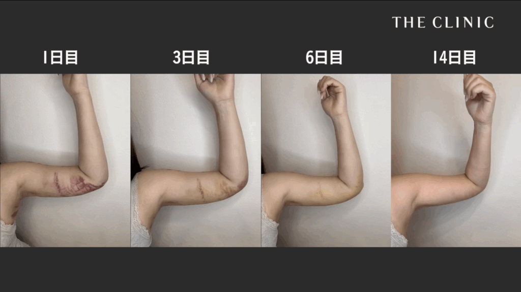 二の腕脂肪吸引のダウンタイムの経過