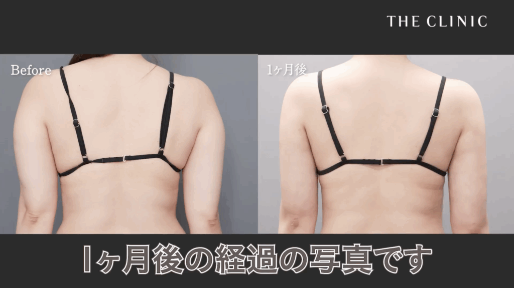 二の腕脂肪吸引1ヶ月後の症例写真