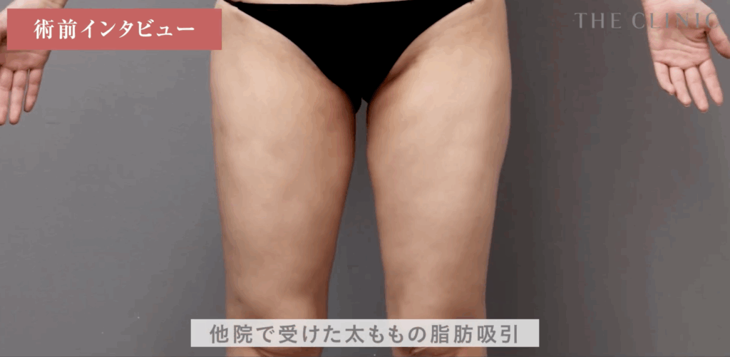 他院で失敗した太もも脂肪吸引症例