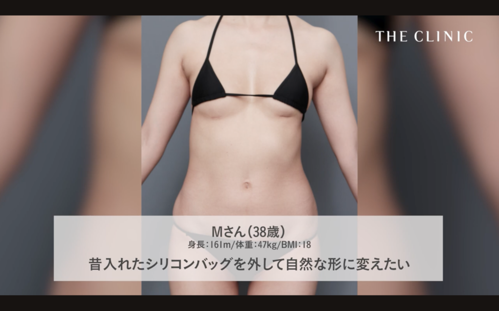 20代前半に他院でシリコンバッグによる豊胸手術を受けたゲスト