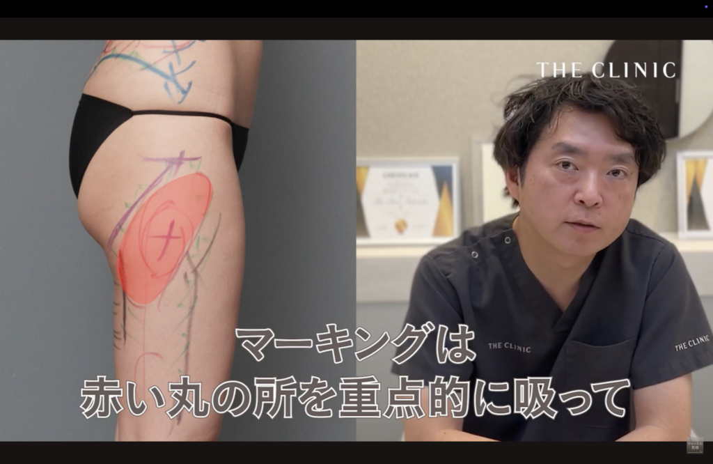 豊胸失敗修正のポイント解説