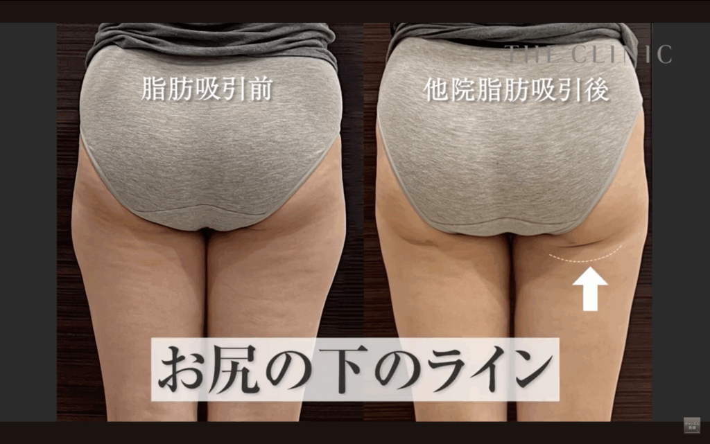 他院で失敗した太もも脂肪吸引の写真