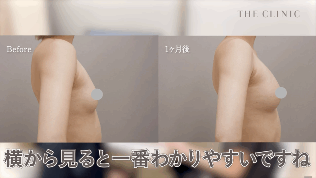 脂肪注入豊胸1ヶ月後の症例写真