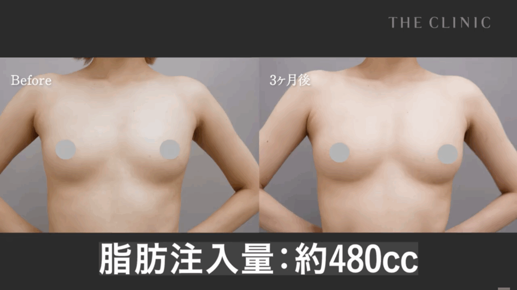 脂肪注入豊胸3ヶ月後の症例写真
