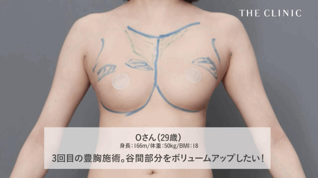 谷間部分のボリュームアップ希望の3回目の豊胸施術に挑むゲスト
