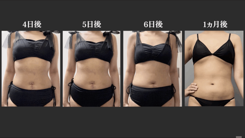 体験レポート】お腹と腰の360°脂肪吸引｜くびれ完成までのダウンタイム