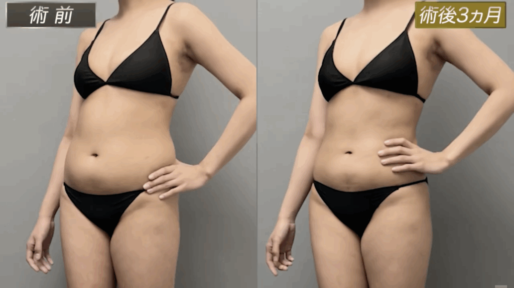 体験レポート】お腹と腰の360°脂肪吸引｜くびれ完成までのダウンタイム
