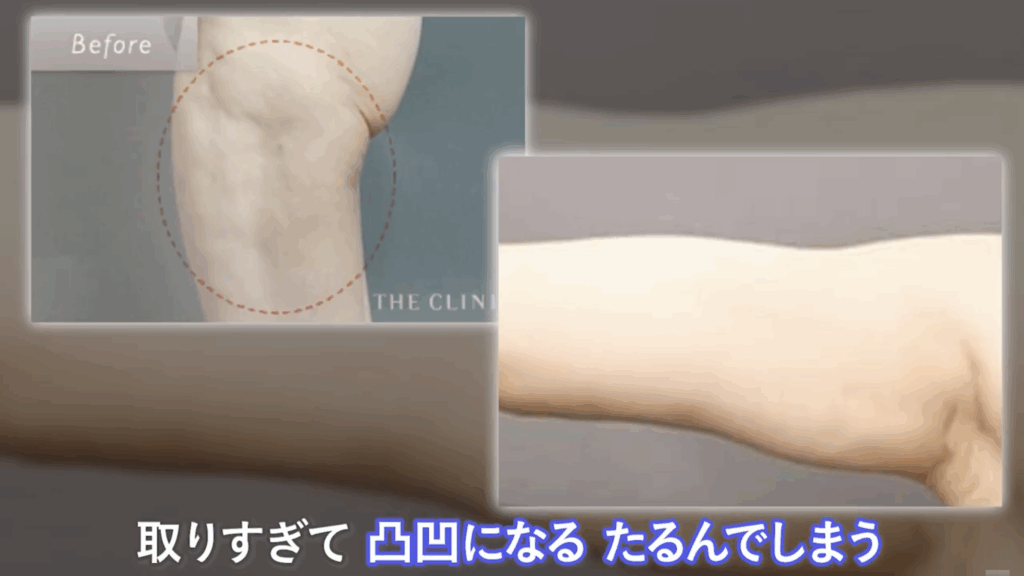 脂肪の取りすぎで皮膚が凸凹になったり、たるんでしまった症例