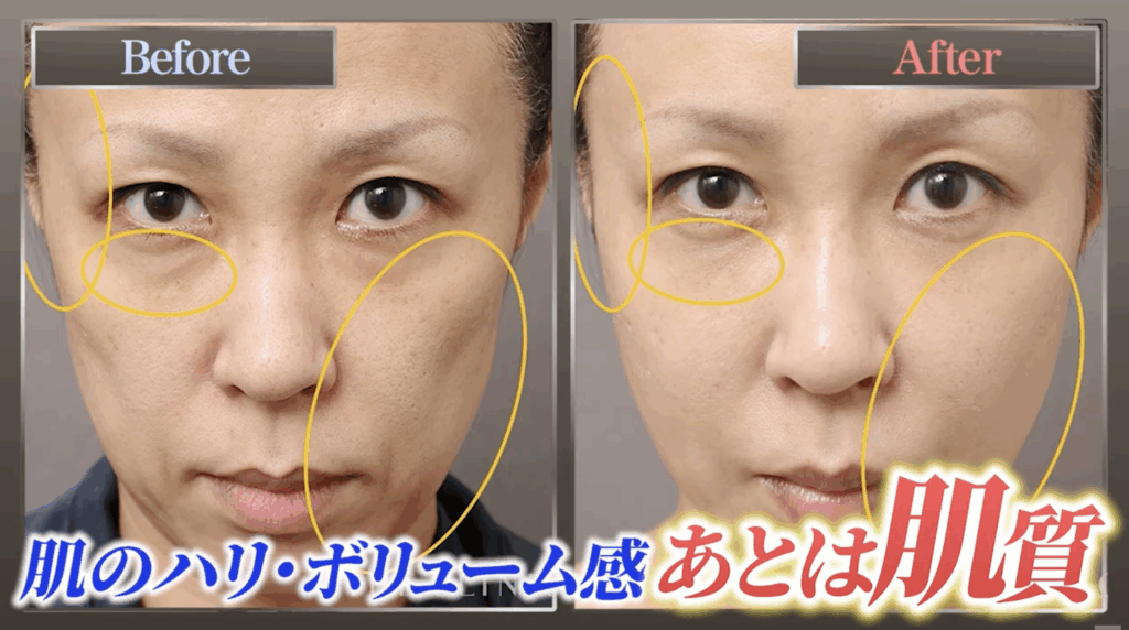 凍結脂肪を活用した若返り治療の症例