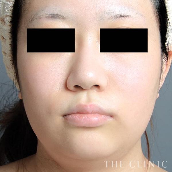 顔の脂肪吸引の症例写真