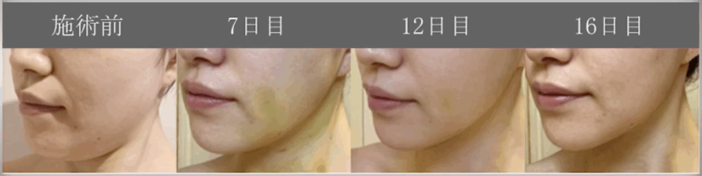 顔の脂肪吸引のダウンタイム経過