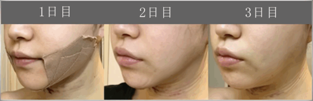 顔の脂肪吸引のダウンタイム経過