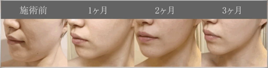 顔の脂肪吸引のダウンタイム経過
