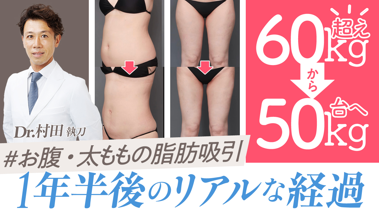 60kg超から50kg台へ。お腹・太ももの脂肪吸引から1年半後のリアルな経過
