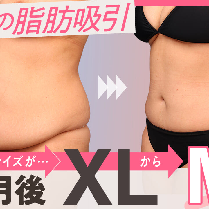 XLからMサイズへ、6ヶ月後に実感したお腹の変化｜THE CLINIC（ザ