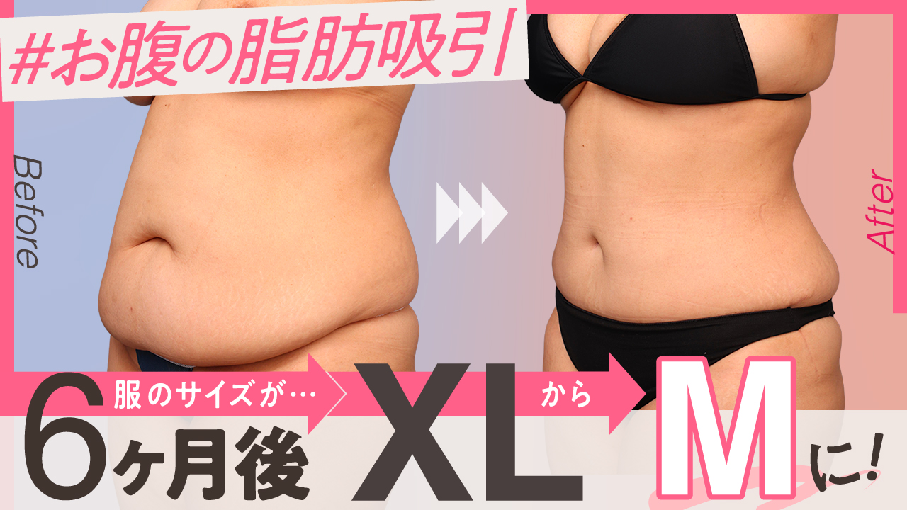 XLからMサイズへ、6ヶ月後に実感したお腹の変化