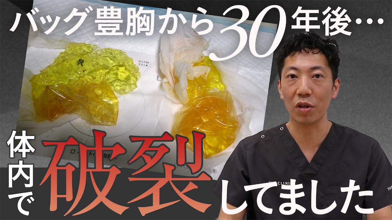 胸が硬い…30年前に入れた豊胸シリコンバッグの衝撃症例から医師が警笛