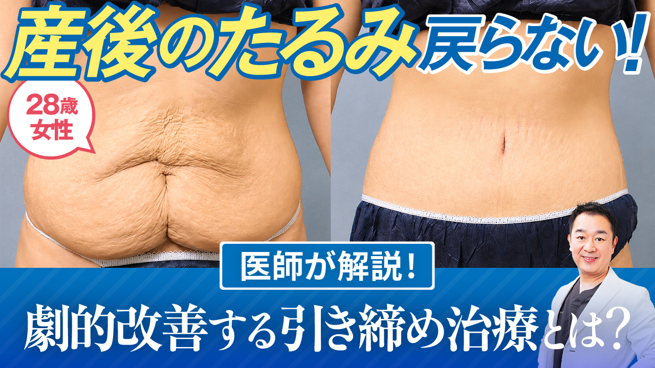 産後のお腹のたるみが戻らない人は必見！劇的改善する治療と症例を医師が解説