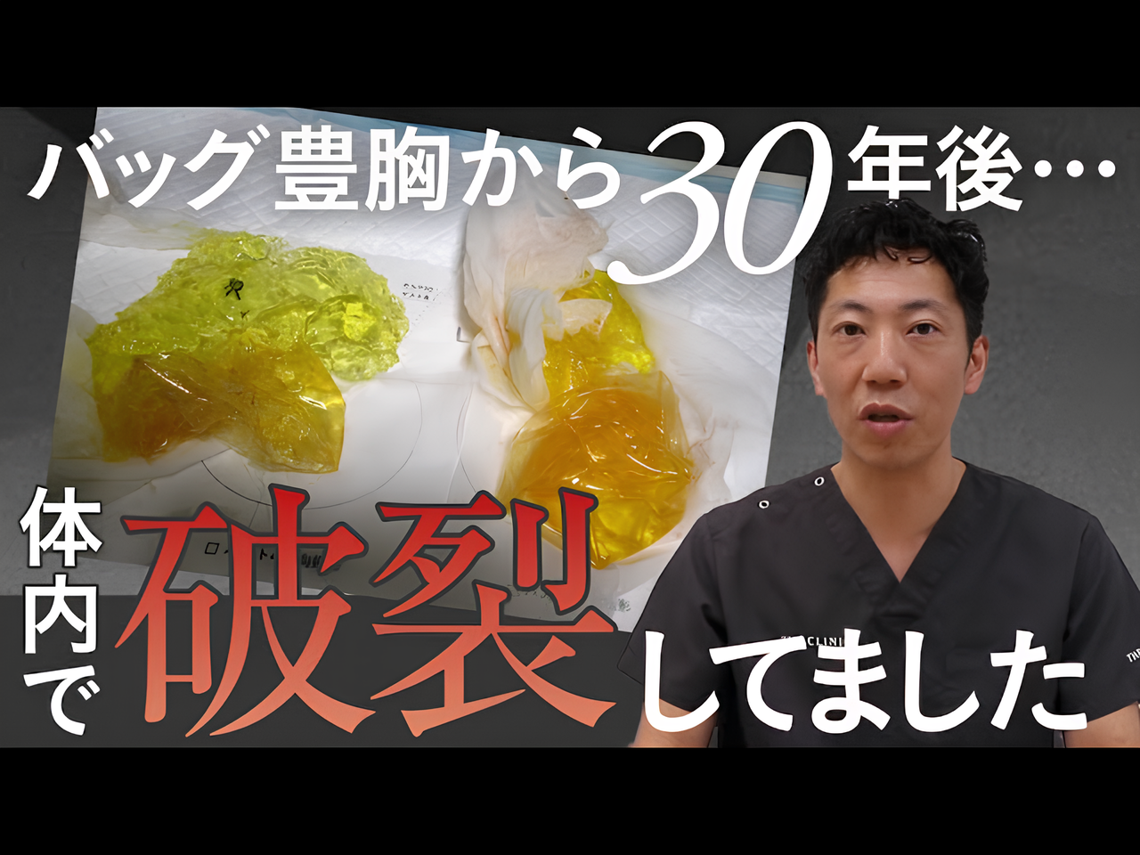 胸が硬い…30年前に入れた豊胸シリコンバッグの衝撃症例から医師が警笛