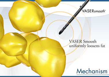 VASER Smooth(ベイザースムース)によるセルライト治療について、山川会長が日本美容外科学会で発表