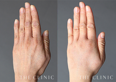 手の若返り治療「ハンドリバイブ」のモニター症例を追加しました。