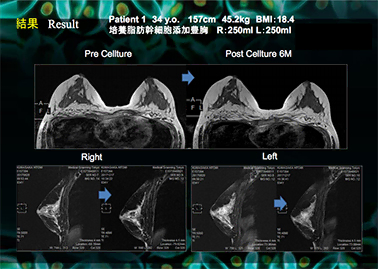 脂肪豊胸の研究成果について日本形成外科学会総会で発表を行いました