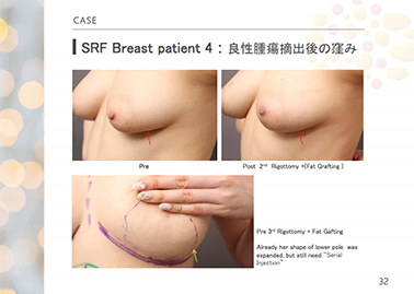 凍結保存脂肪の研究成果について日本形成外科学会総会で発表を行いました