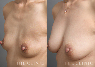 コンデンスリッチ豊胸のモニター症例を追加しました。