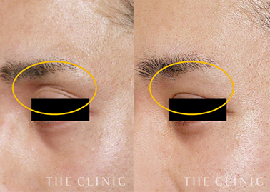 3Dマルチレイヤー注入のモニター症例を追加しました。