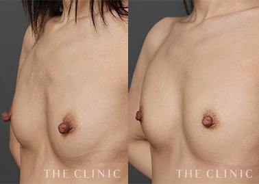 コンデンスリッチ豊胸のモニター症例を追加しました。